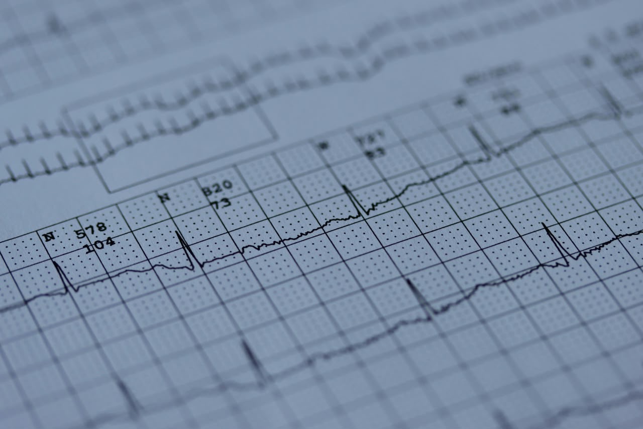 ECG / EKG sample