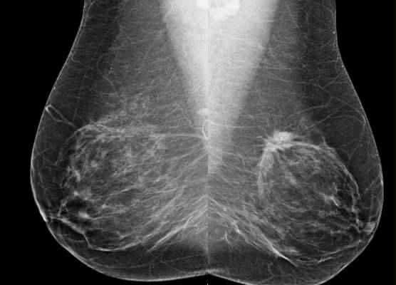 Mammography sample